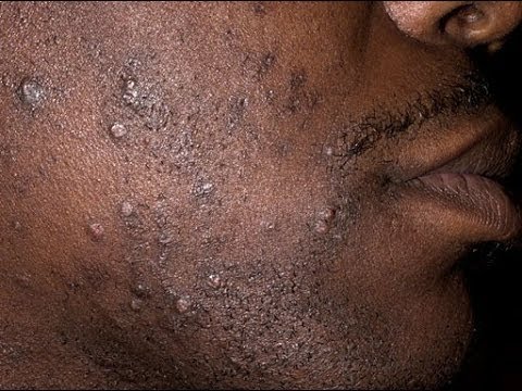 Quels antibiotiques accepter des boutons sur la personne