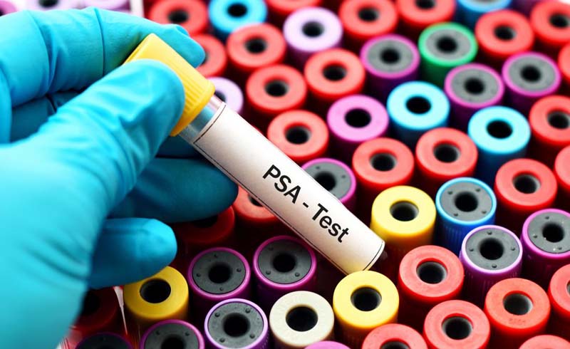 PSA test