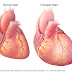 Enlarged Heart Symptoms - Enlarged Heart Causes and Remedies