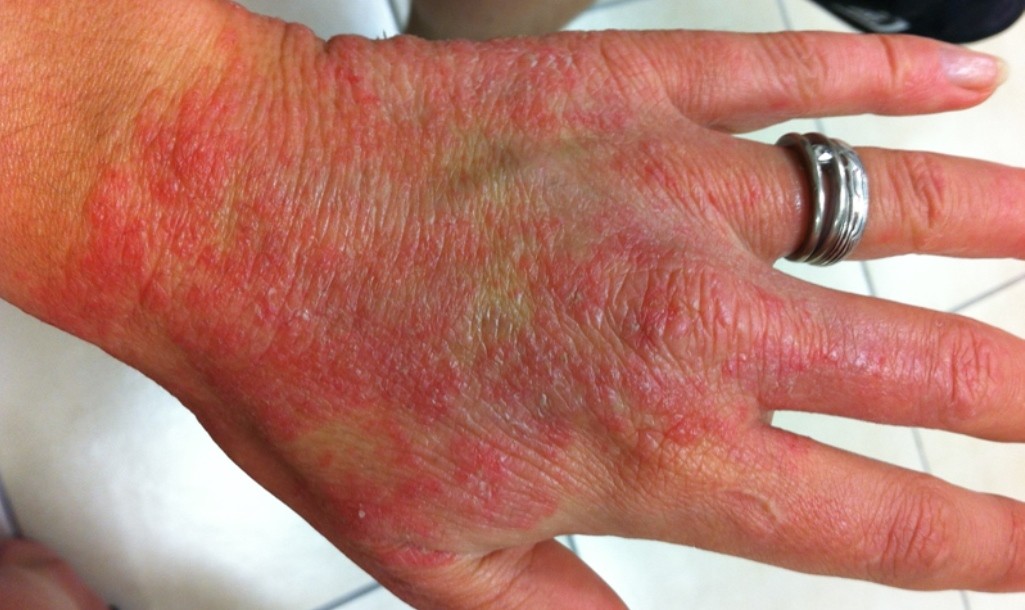 allergie voor wolvet allergie voor wolvet