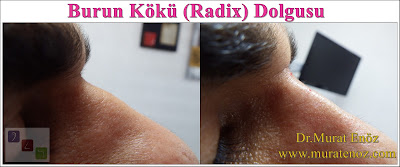 Radix filler - Filling of deep radix with cross-Linked HA filler - Radix augmentation with filler - Nasofrontal augmentation - Filler for low radix - Filling of deep radix - Non-surgical nose job - Non surgical nose job with filler - Non-surgical rhinoplasty - Non-surgical rhinoplasty - Nose filler injection - Non-surgical nose job in Istanbul -  Non-surgical nose job istanbul -  Nose filler injection Turkey