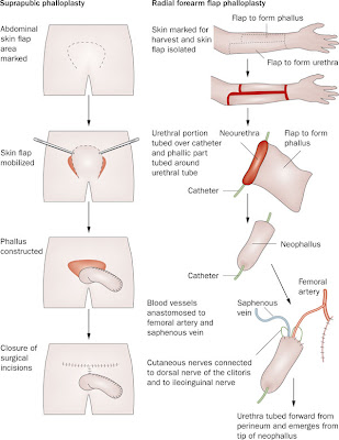 sex change surgery procedure from female to male