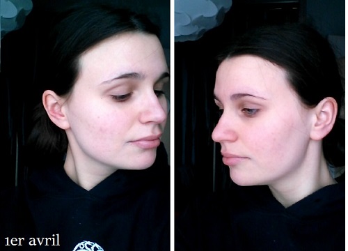 Au fil d'Ariane: Aventure Roaccutane, partie 4 - le bilan Au fil d'Ariane: Aventure Roaccutane, partie 4 - le bilan