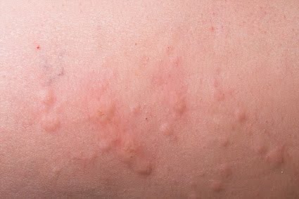 3 Ways to Treat Hives in Children - wikiHow