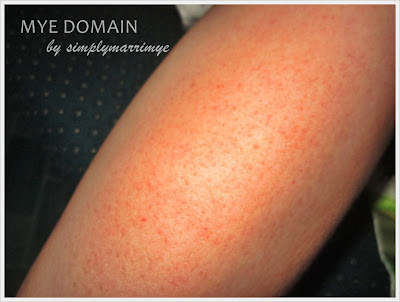 Leg Rash - Symptoms, Causes, Treatments - Healthgrades