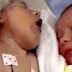 Né sans cerveau à cause d'une malformation congénitale. Ce que les parents de ce bébé font est agonisant.