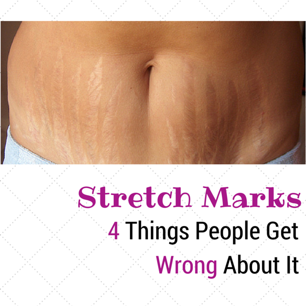 Stretch Marks 4 Things People Get Wrong About It SpaMedica