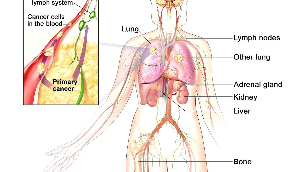 Lung Cancer Stage 4 Life Expectancy Without Treatment ...