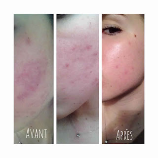 Les huiles essentielles anti-acné Les huiles essentielles anti-acné