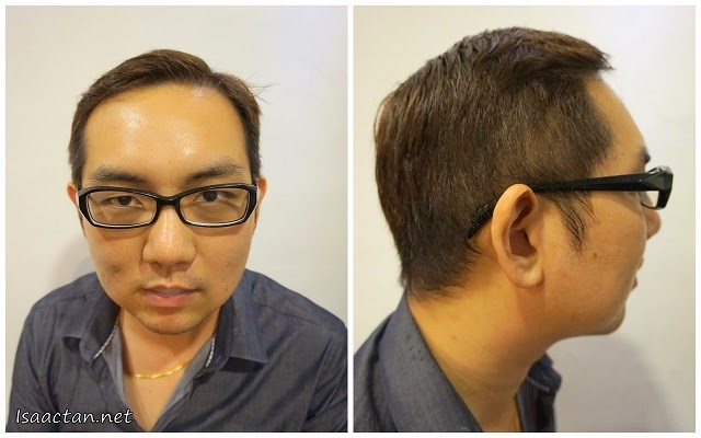 An immediate 'After Treatment' picture of my front and side profile after the first treatment of MesoLipo procedure An immediate 'After Treatment' picture of my front and side profile after the first treatment of MesoLipo procedure