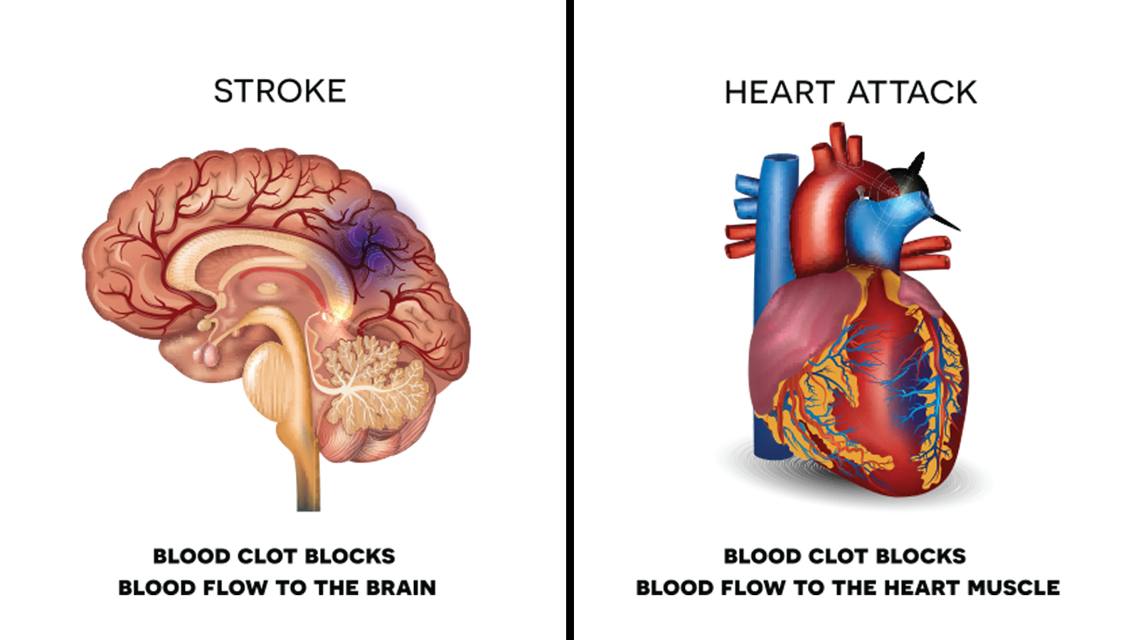 Ubat Sakit Jantung Bengkak - Contoh O