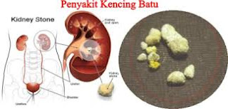 Foto Obat batu ginjal di Magelang Jawa Tengah