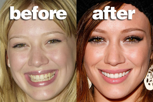 Designed Smiles: Some Celebrities Who Had Cosmetic Dentistry Done
