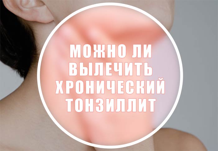 хронический тонзиллит