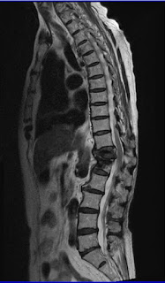 whole spine MRI