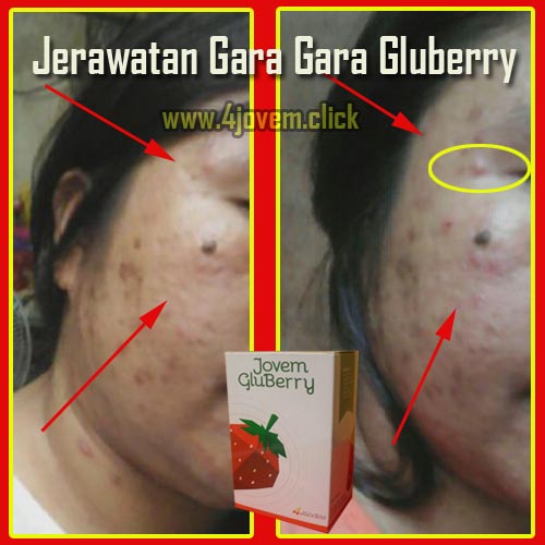 Jerawatan Setelah Minum Gluberry Jerawat Bertambah Habis Konsumsi Gluberry