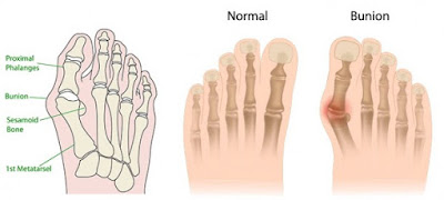 Powerful Natural Remedy To Get Rid Of Bunions