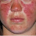 Immunology: MCQ on Immune Tolerance & Autoimmunity