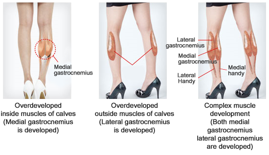 Botox for leg slmming calf muscles