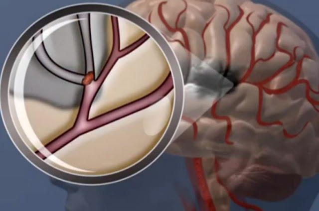 Causes Stroke and Symptoms of a Mild Stroke That Should Be Avoided Causes Stroke and Symptoms of a Mild Stroke That Should Be Avoided