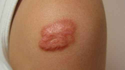 Obat Salep Untuk Keloid di Apotek Obat Salep Untuk Keloid di Apotek