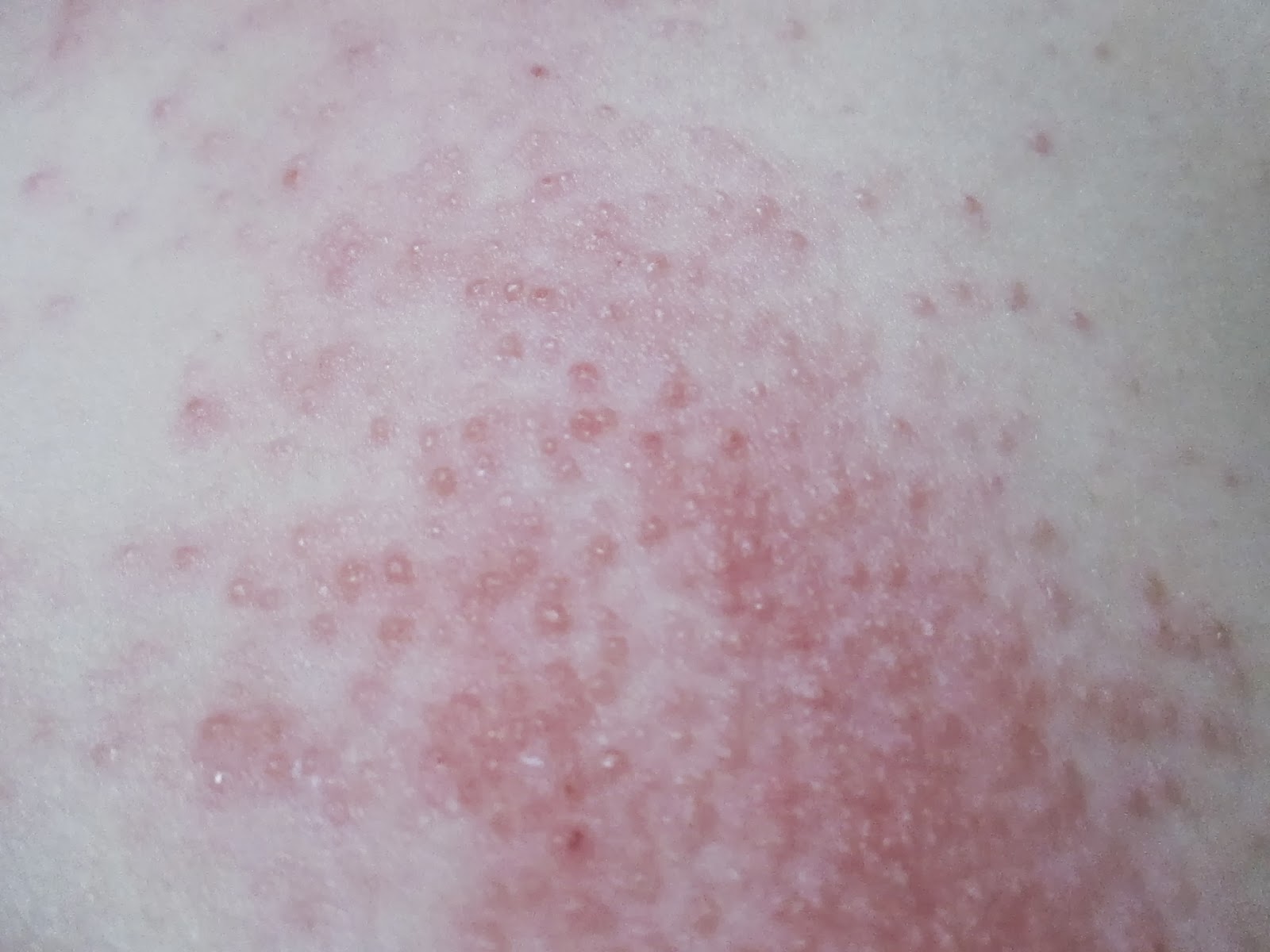 hepatitis rash