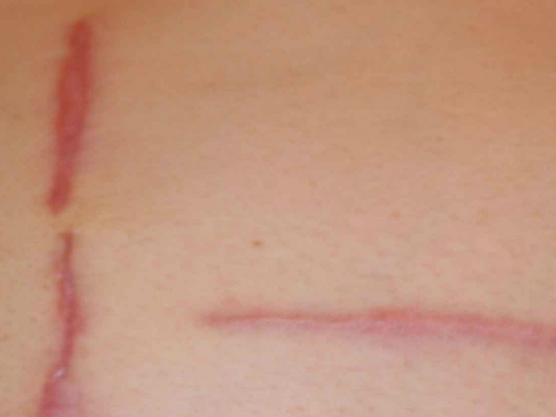 Keloid Removal At Your Home