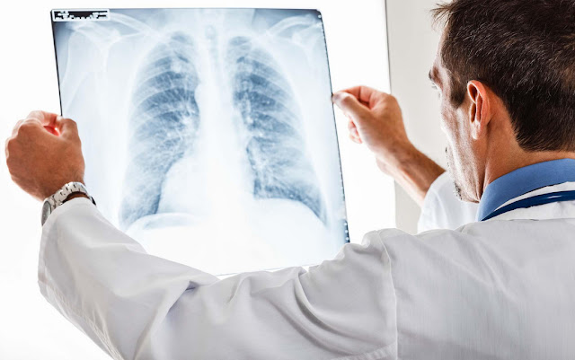 Lung cancer symptoms in men signs that often occurs Lung cancer symptoms in men signs that often occurs