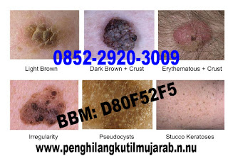 Mengobati kutil kemaluan kelamin tanpa operasi obat kutil - di kulit kemaluan kelamin, penis pria laki-laki, vagina luar dan dalam, perempuan wanita Ibu hamil menyusui mengandung, obat penghilang kutil menghilangkan kutil tanpa operasi yang terbukti dan aman terpercaya, obat penghilang kutil di kelamin, anus dubur, paha dsb