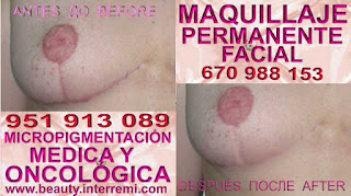 cáncer de mamas cicatrices cáncer de mamas cicatrices Tratamiento cicatrices luego de reduccion pechos