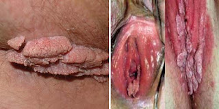 Foto Obat Kutil Yang Tumbuh Di Dalam Vagina Herbal