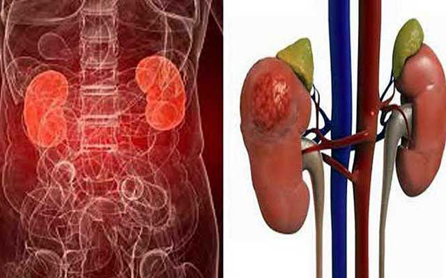 Kidneys that are forgotten six forgotten! যে ছয়টি ভুলে নষ্ট হয় কিডনি!
