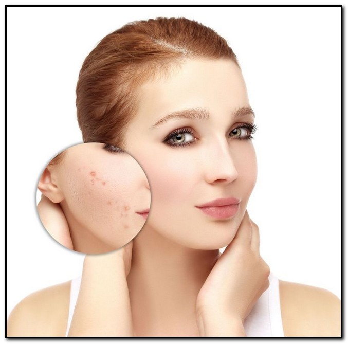 Tips acne treatment during pregnancy SKIN PROBLEMS