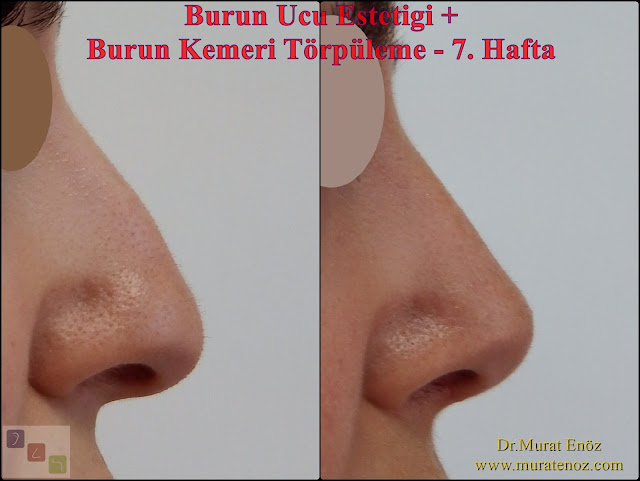 Nose tip plasty Istanbul - Nose tip lifting Turkey - Nasal hump removal - Nasal hump reduction - Rhinoplasty without bone breaking in Istanbul - Nose job without breaking bone - Nasal aesthetic surgery without breaking the bone in Istanbul - Rhinoplasty without breaking nose bone in Turkey