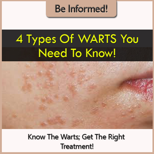 Wart Remover Tips 4 Types Of Warts Which One Do You Have? Find Out Now!