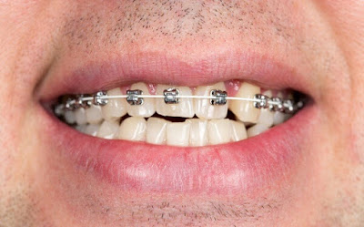 Ý nghĩa của răng khểnh là gì?