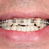Ý nghĩa của răng khểnh là gì?