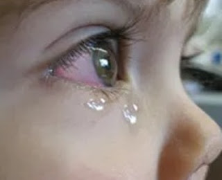 Pink Eye Symptoms (Conjunctivitis)