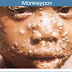 Monkeypox spreads to 11 states