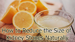 How to Reduce the Size of Kidney Stones Naturally How to Reduce the Size of Kidney Stones Naturally