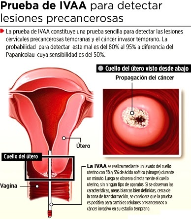 Prueba del IVAA Dibujo alusivo a la prueba del IVAA para detectar lesiones precancerosas