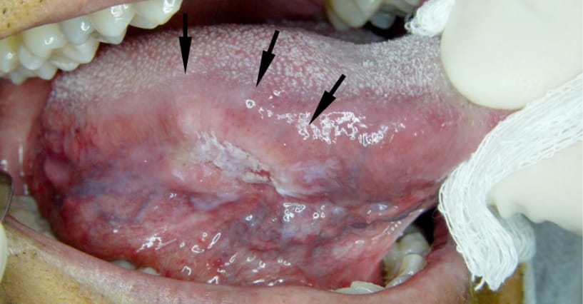 Squamous Cell Carcinoma Tongue Survival Rate