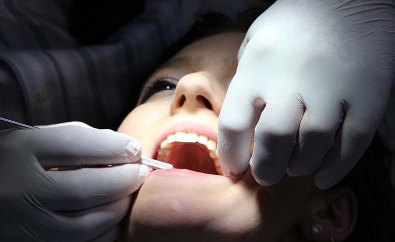 Professionally whitened teeth