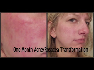 scarlet letters dealing with vascular rosacea and the rest