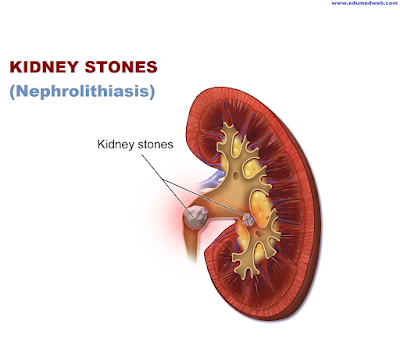 kidney-stone-renal-stone