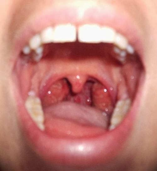 son contagiosas las anginas con pus