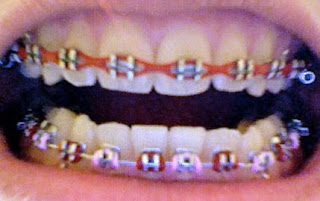 braces.D:: Power Chain!!