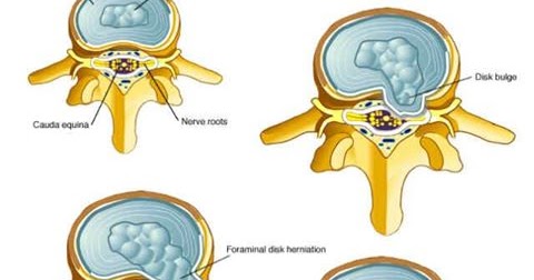 Дорзальная диффузная грыжа что это. Дорзальная диффузная грыжа что это. Дорзальная диффузная грыжа что это. Позвоночник диск l5-s1 грыжа. Парамедианно фораминальная грыжа.