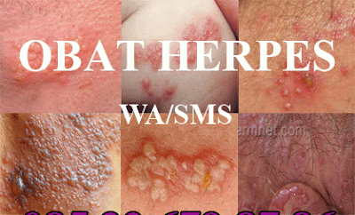Foto Resep Obat Herpes Selangkangan Dan Kelamin