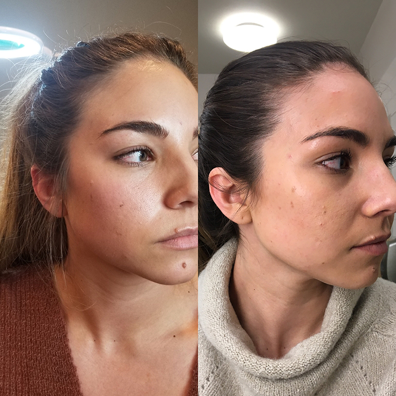 Getting Botox Therapy For TMJ And Jaw Pain Relief